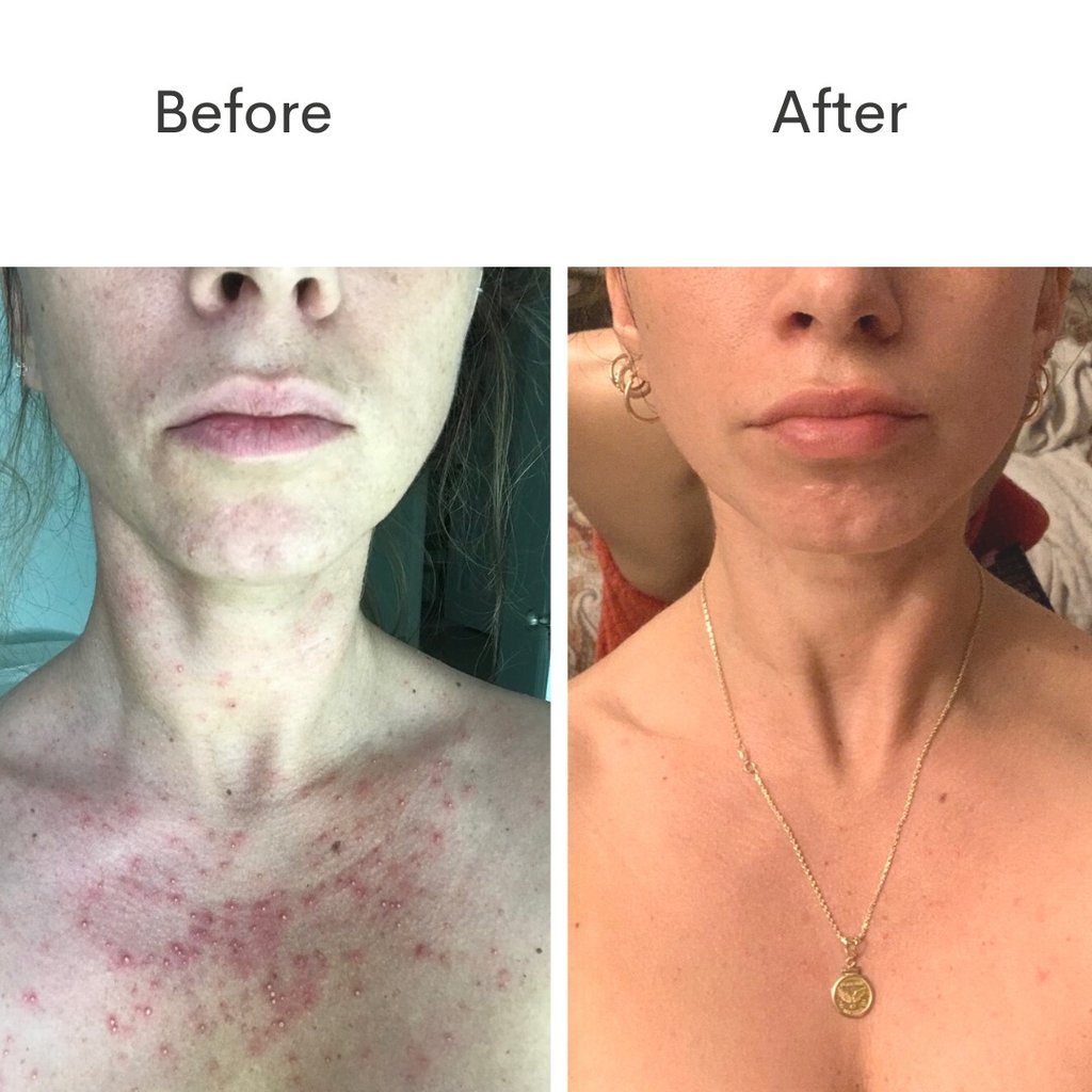 Before & After Results: Adult acne woes solved with 6 weeks of You Dew You.